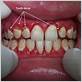 diseases that causes teeth to break at the gum line