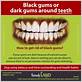 do black gums mean gum disease