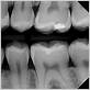 do dental x rays show gum disease