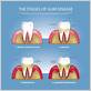do dentures stop gum disease