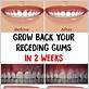 do your gums grow back after periodontal disease