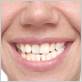 does a crooked jaw cause gum disease