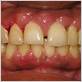 does amlodipine cause gum disease