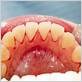 does ebv cause gum disease