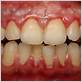 does gum disease cause gaps in teeth