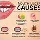 does gum disease cause mouth sores