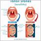 does gum disease cause tonsil stones
