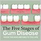 does gum disease go away when all teeth are removed