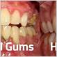 does gum disease hurt