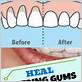 does gums heal fast