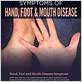 does hand foot and mouth disease cause bleeding gums
