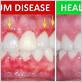 does having gum disease hurt