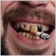 does smoking weed cause gum disease