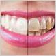 does teeth whitening remove stains