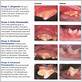 dog plaque and gum disease