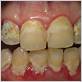 dry mouth gum disease