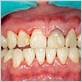 early periodontal disease gums