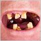 early signs of gum disease from chewing tobacco