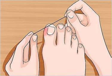 early stage dental floss ingrown toenail