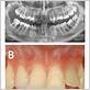 ehlers danlos syndrome gum disease