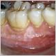 emphysema gum disease skin discoloration and leukemia