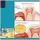 enzyme suppressant for gum disease