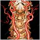 external carotid artery and severe gum disease