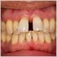 false teeth with gum disease