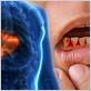 fatty liver and gum disease