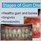 final stage of gum disease