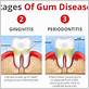 first signs of gum disease