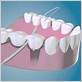 floss dental bridge