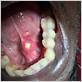 frenulum gum disease