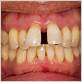 gap between front teeth gum disease