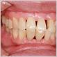 gaps between teeth gum disease