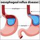 gastroesophageal reflux disease and chewing gum