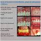 gingival description dental hygiene