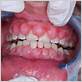 gingival hyperplasia gum disease
