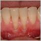 gingival recession and over use of waterpik