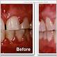 gingivitis before after