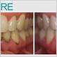 gingivitis before and after