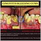 gingivitis bleeding gums