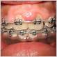 gingivitis gum disease with braces