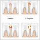 gingivitis healing stages