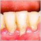 gingivitis plaque on teeth