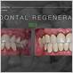 gum and bone regeneration after periodontal disease