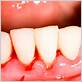 gum bleeding between teeth