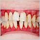 gum disease 15090