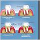 gum disease abd teeth pain