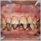 gum disease after smoking